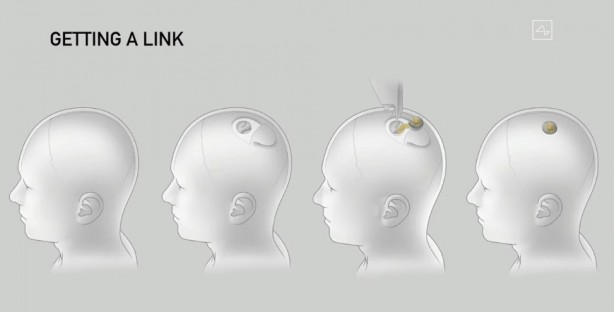 Foto - Küreselciler insanlığı robotlaştırmak için iş başında! Ve Elon Musk çipi tanıttı