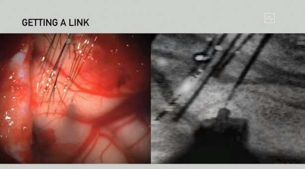 Foto - Küreselciler insanlığı robotlaştırmak için iş başında! Ve Elon Musk çipi tanıttı