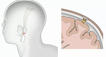 Foto - Küreselciler insanlığı robotlaştırmak için iş başında! Ve Elon Musk çipi tanıttı