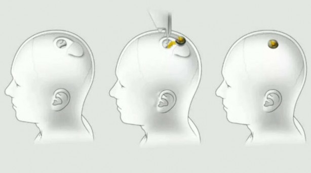 Foto - Küreselciler insanlığı robotlaştırmak için iş başında! Ve Elon Musk çipi tanıttı