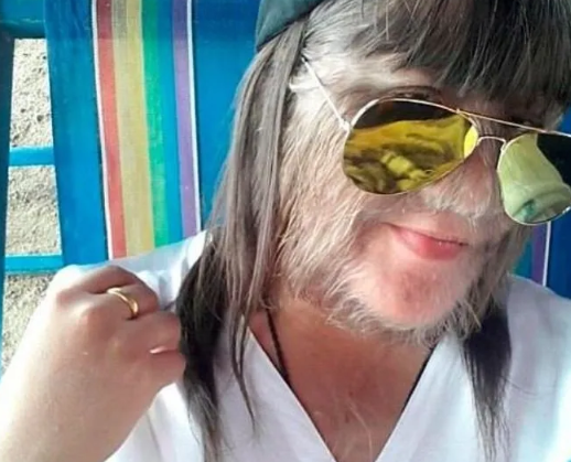 Foto - "Kurt kız" büyüdü! Dünyanın en tüylü kızıydı: Son halini gören şok oluyor