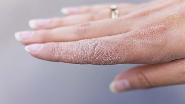Kuru ve çatlak eller için evde uygulayabileceğiniz 5 yöntem