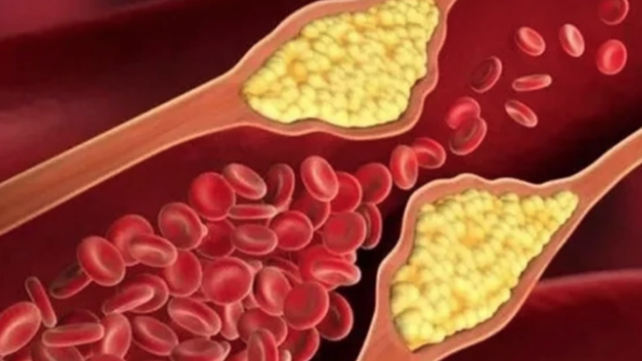 LDL, mg/dL'nin altına... Kolesterolde 'İyi-kötü' devri kapandı: Yeni nesil kılavuz açıklandı