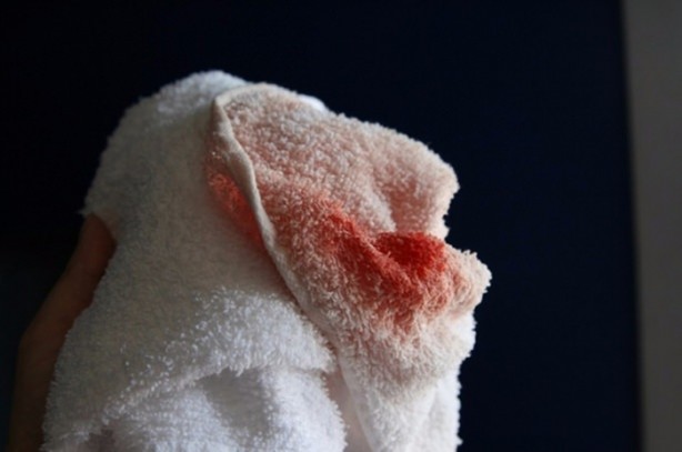 Foto - Lekeleri çıkarmak için doğal yöntemler