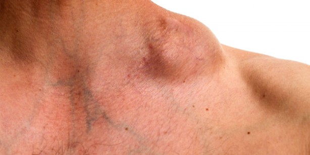 Foto - Lenfomayı işaret eden 10 yaygın belirti