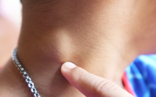 Foto - Lenfomayı işaret eden 10 yaygın belirti