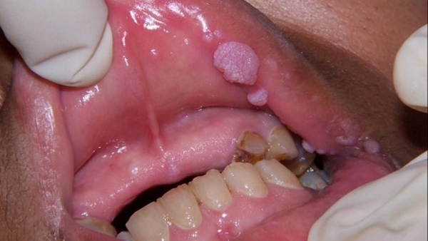 Foto - Limon kabuğu yağı siğile iyi geliyor!