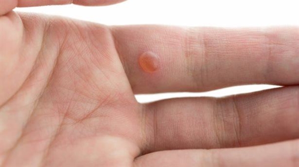 Foto - Limon kabuğu yağı siğile iyi geliyor!