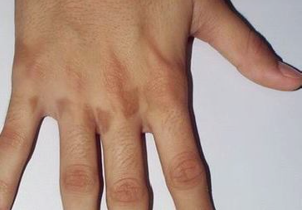 Foto - Limonata yaparken dikkat etmezseniz sonunuz böyle olabilir!