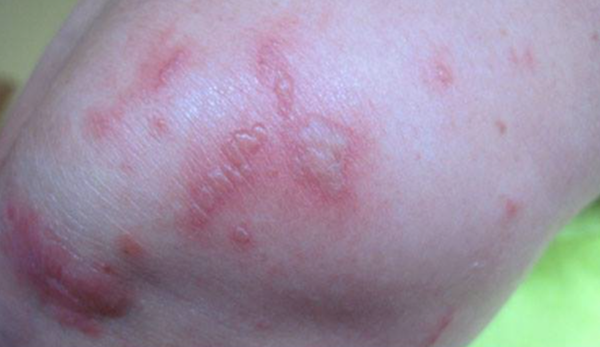 Foto - Limonata yaparken dikkat etmezseniz sonunuz böyle olabilir!