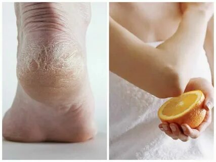 Foto - Limonu topuklarınıza sürerseniz bakın ne oluyor! O hastalıkları şıp diye kesiyor