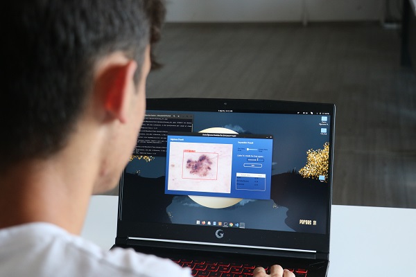 Foto - Lise öğrencisi geliştirdi! Cilt kanseri bu yöntemle teşhis edilebilecek