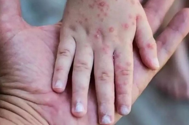 Foto - Maymun çiçeği alarmı! Kıta genelinde acil durum ilan edildi