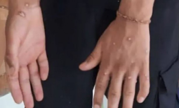 Foto - Maymun çiçeği alarmı! Kıta genelinde acil durum ilan edildi