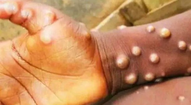 Foto - Maymun çiçeği alarmı! Kıta genelinde acil durum ilan edildi