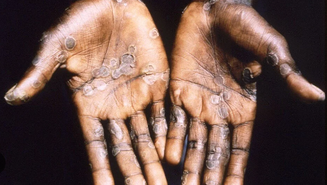 Foto - Maymun çiçeği virüsü bakın nasıl bulaşıyormuş! 30 dakika biriyle aynı odada...