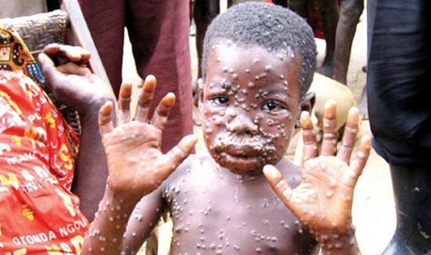 Foto - Maymun çiçeği virüsü bakın nasıl bulaşıyormuş! 30 dakika biriyle aynı odada...