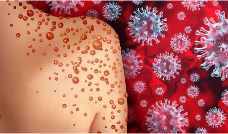 Foto - Maymun çiçeği virüsü bakın nasıl bulaşıyormuş! 30 dakika biriyle aynı odada...