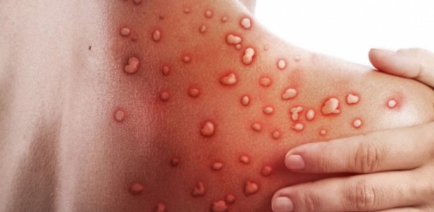 Foto - Maymun çiçeği virüsü bakın nasıl bulaşıyormuş! 30 dakika biriyle aynı odada...