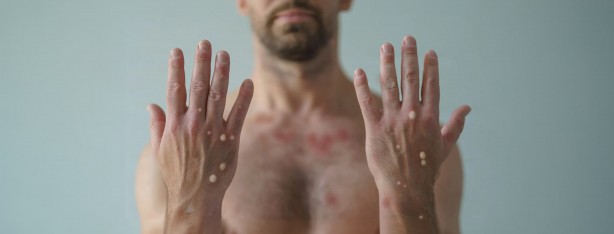 Foto - Maymun çiçeği virüsü bakın nasıl bulaşıyormuş! 30 dakika biriyle aynı odada...