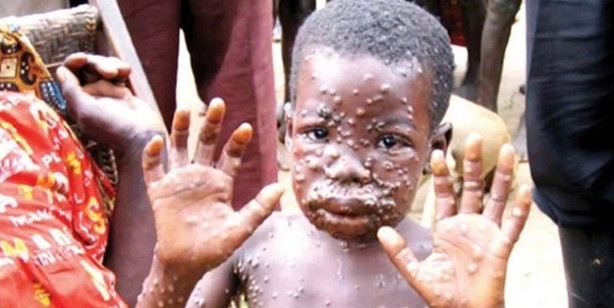 Foto - Maymun çiçeği virüsü nedir? Maymun çiçeği virüsü nasıl bulaşır? Maymun çiçeği Monkeypox belirtileri nedir, tedavisi var mı?