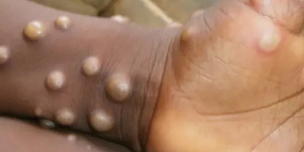 Foto - Maymun çiçeği virüsü nedir? Maymun çiçeği virüsü nasıl bulaşır? Maymun çiçeği Monkeypox belirtileri nedir, tedavisi var mı?