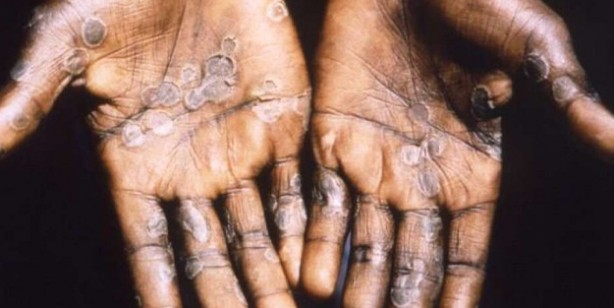 Foto - Maymun çiçeği virüsü nedir? Maymun çiçeği virüsü nasıl bulaşır? Maymun çiçeği Monkeypox belirtileri nedir, tedavisi var mı?