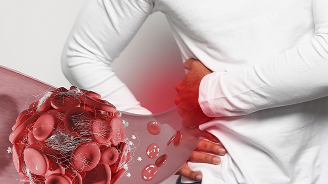 Foto - Karaciğerdeki kanserin kaynağı başka organ olabilir! Meme kanseri ve karaciğer kanserinde bilinmeyen detay