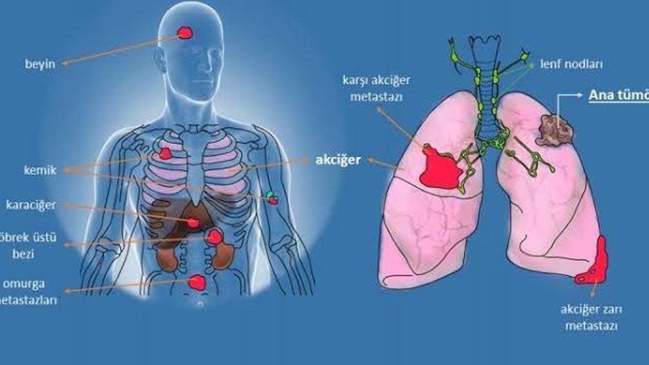 Foto - Karaciğerdeki kanserin kaynağı başka organ olabilir! Meme kanseri ve karaciğer kanserinde bilinmeyen detay