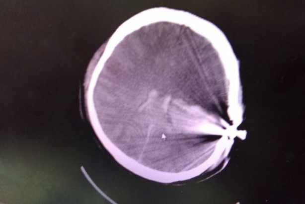 Foto - Merminin balistik incelenmesinin yapılması için kafasından çıkarılması gerek