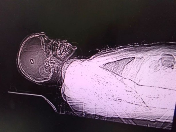 Foto - Merminin balistik incelenmesinin yapılması için kafasından çıkarılması gerek