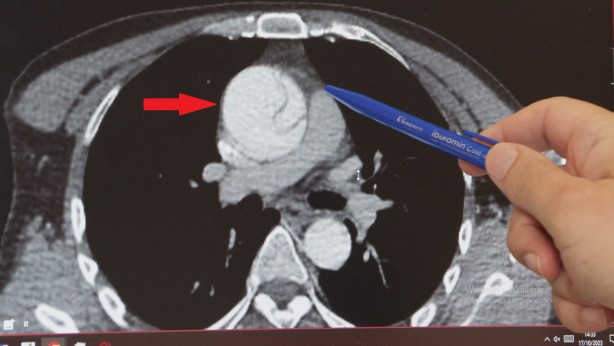 Foto - Mide ağrısı deyip geçmeyin! Az kalsın ölüyordu