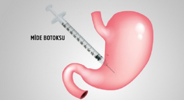 Foto - Mide botoksu ile ilgili 5 soru 5 cevap