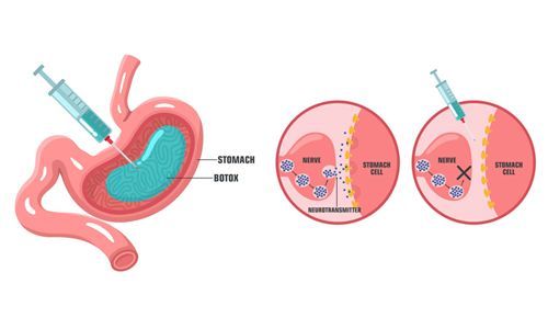 Foto - Mide botoksu ile ilgili 5 soru 5 cevap