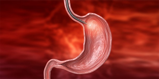 Foto - Mide botoksu ile ilgili 5 soru 5 cevap