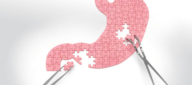 Mide botoksu ile ilgili 5 soru 5 cevap