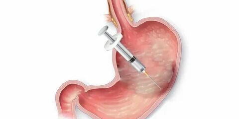 Mide botoksu yaptıranlar dikkat! Ölü sayısı hızla artıyor
