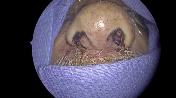 Foto - Mide bulandıran olay! Doktorlar inanamadı! Hastanın burnundan bakın ne çıktı