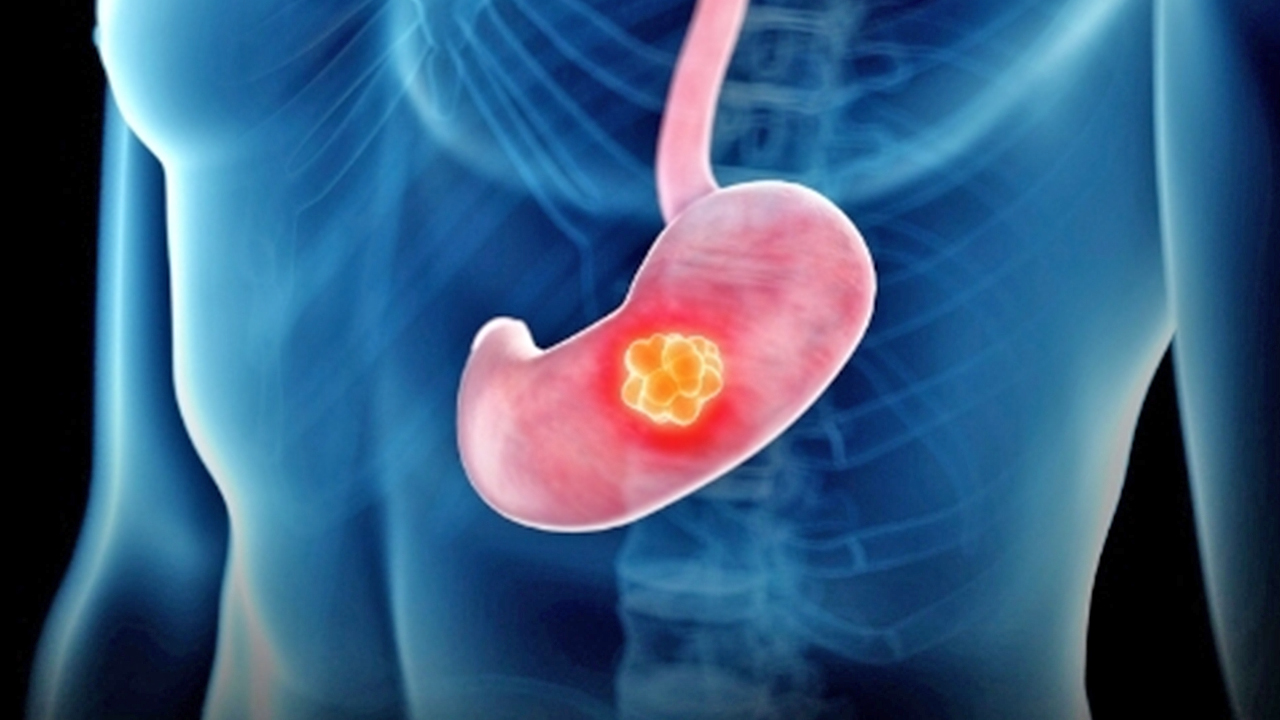 Foto - Mide kanseri iyileşir mi?.. Nasıl teşhis edilir?.. Mide kanserinin erken belirtisinde 8 işaret hayati önem taşıyor