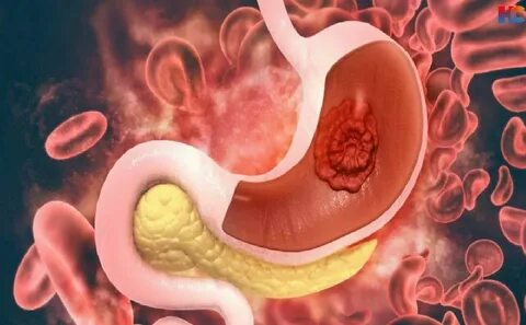 Foto - "Midem yanıyor" deyip geçmeyin! Bu durum, kanserin habercisi olabilir