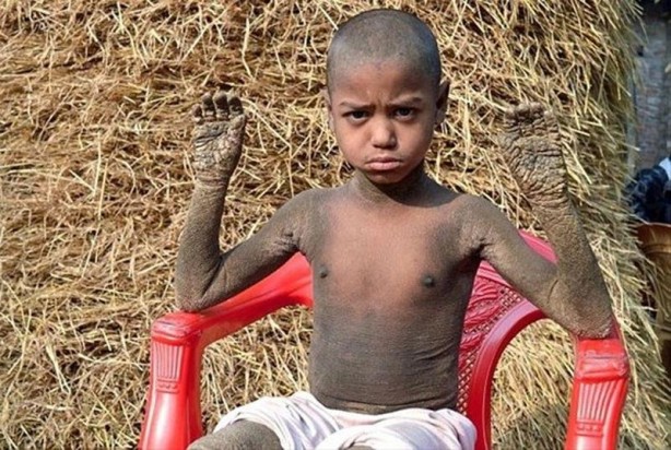 Foto - İşte Dünyanın en garip hastalıkları