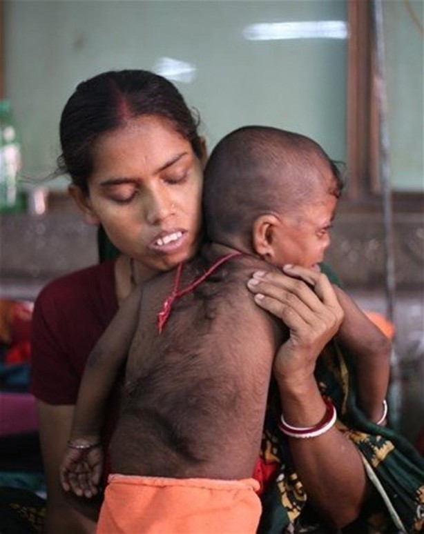 Foto - İşte Dünyanın en garip hastalıkları
