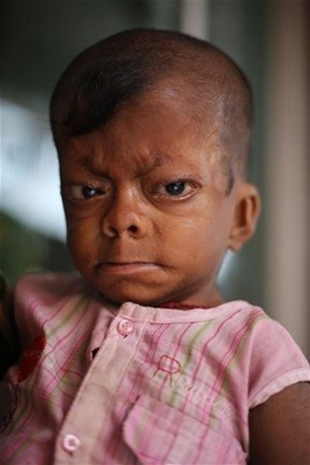 Foto - İşte Dünyanın en garip hastalıkları