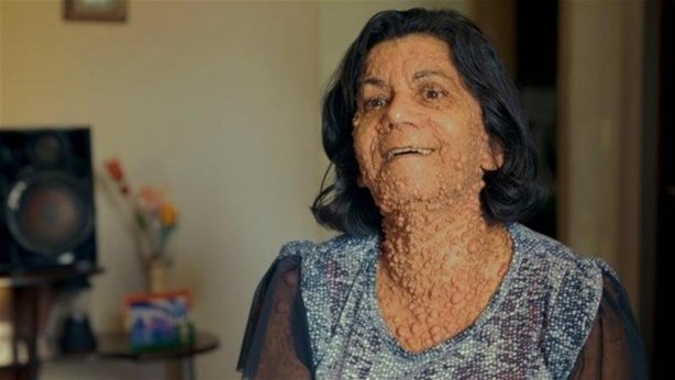 Foto - İşte Dünyanın en garip hastalıkları