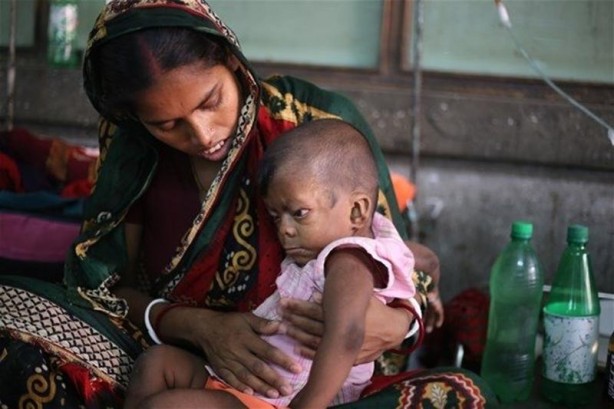 Foto - İşte Dünyanın en garip hastalıkları