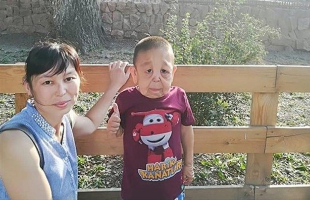 Foto - İşte Dünyanın en garip hastalıkları