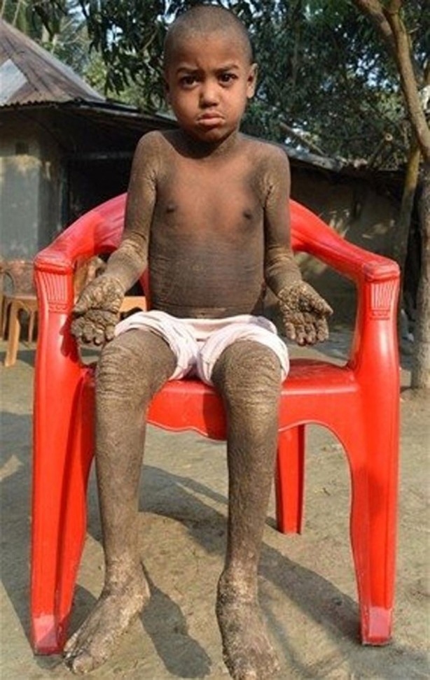 Foto - İşte Dünyanın en garip hastalıkları