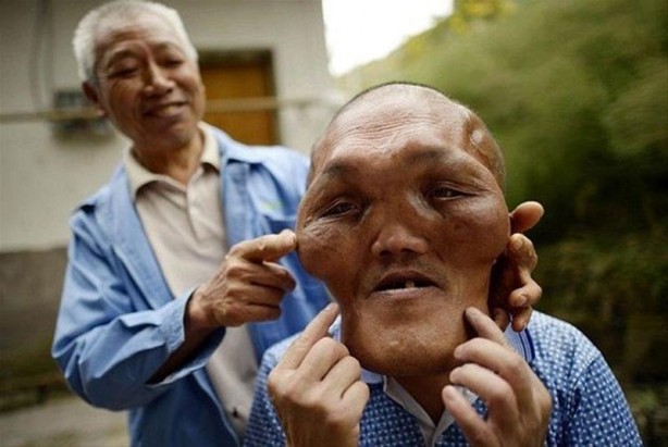 Foto - İşte Dünyanın en garip hastalıkları