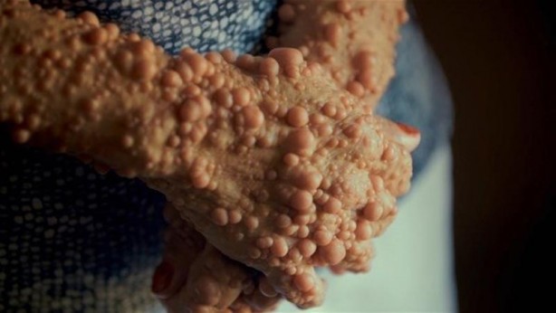 Foto - İşte Dünyanın en garip hastalıkları