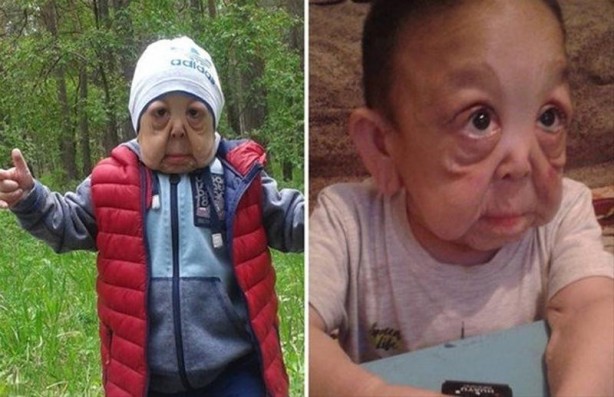 Foto - İşte Dünyanın en garip hastalıkları